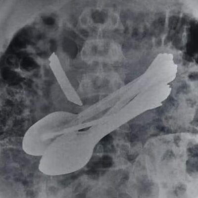 Midesinden kapı kilidi, tornavida, bıçak çıktı!