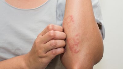 Egzama nedir? Egzamanın tedavisi nasıldır?