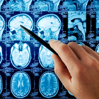 MS hastalarında günlük beslenme nasıl olmalı?