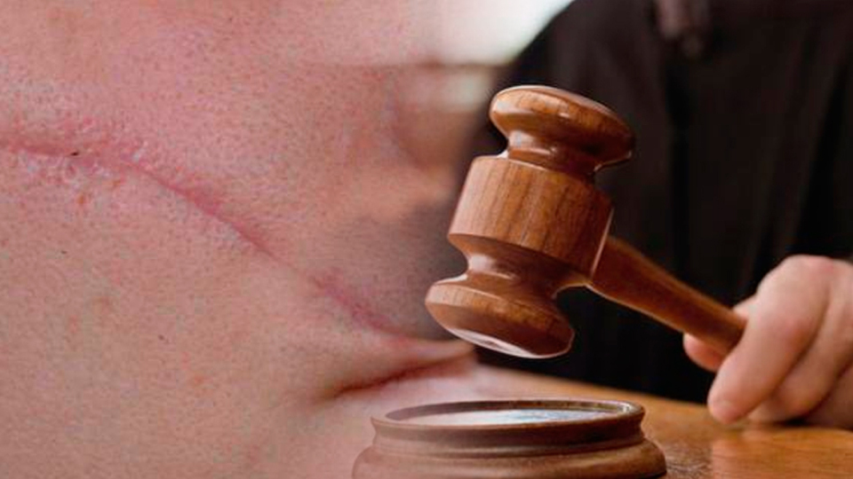 Yargıtay'dan 'scar face' kararı!