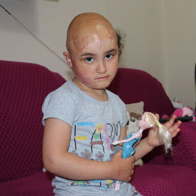 Kızgın yağ döküldü hayatı karardı!