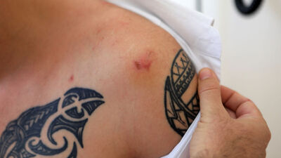 Tartıştığı kişi tarafından ısırılınca kuduz aşısı yapıldı