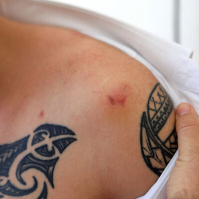 Tartıştığı kişi tarafından ısırılınca kuduz aşısı yapıldı