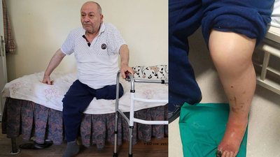 Ayak parmağı kesilecekti bacağından oldu!