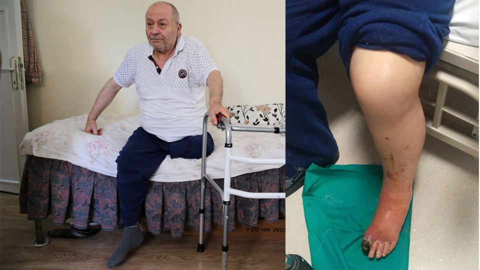 Ayak parmağı kesilecekti bacağından oldu!