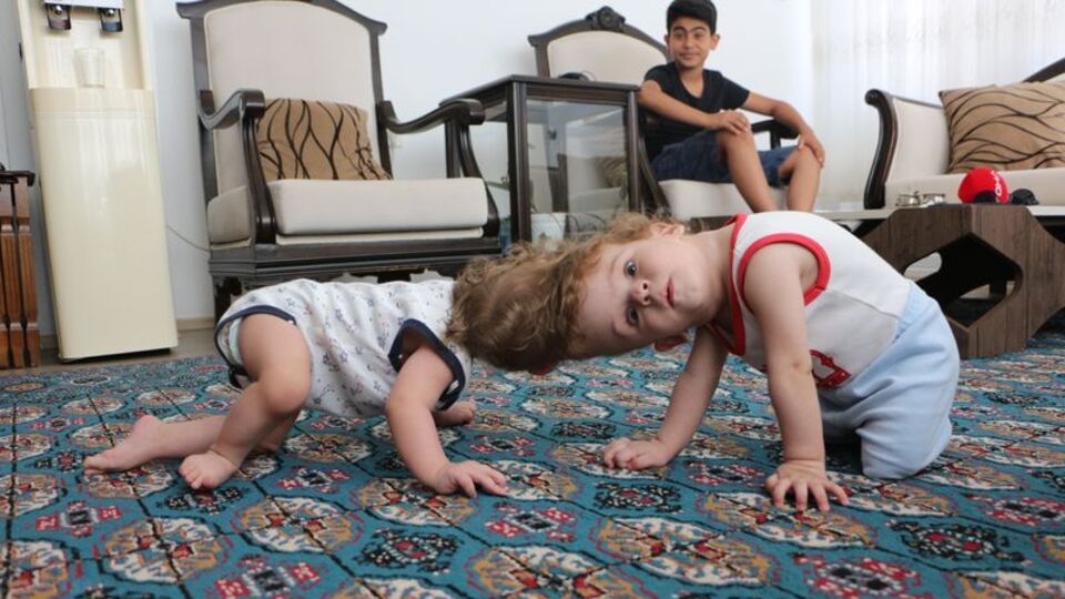 Siyam ikizleri 1 yaşında!