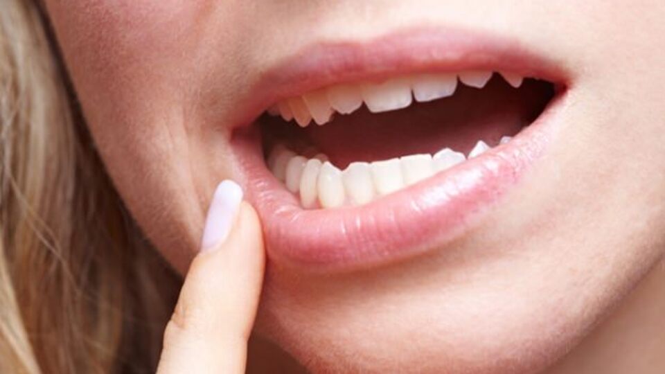 Ağız yarası nedir?