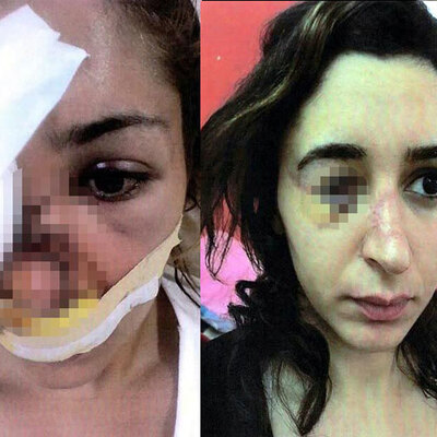 Yüzünü parçaladı, zorla evlendi! Tuğçe'nin kabusu bitmedi