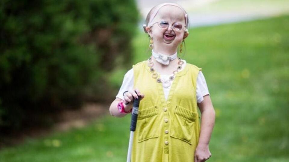 Hallermann-Streiff Sendromu nedir?