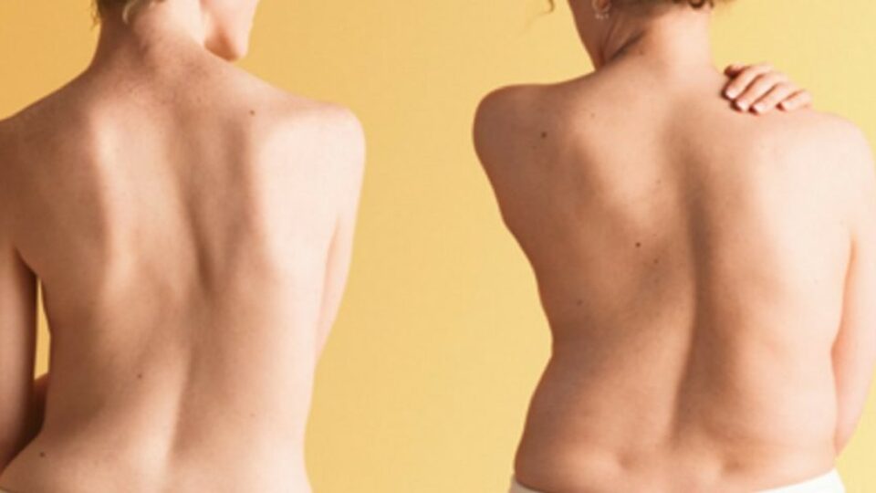 Bu belirtiler skolyoza işaret!