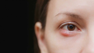 Çoğu insanın sorunu... İşte arpacık belirtileri!