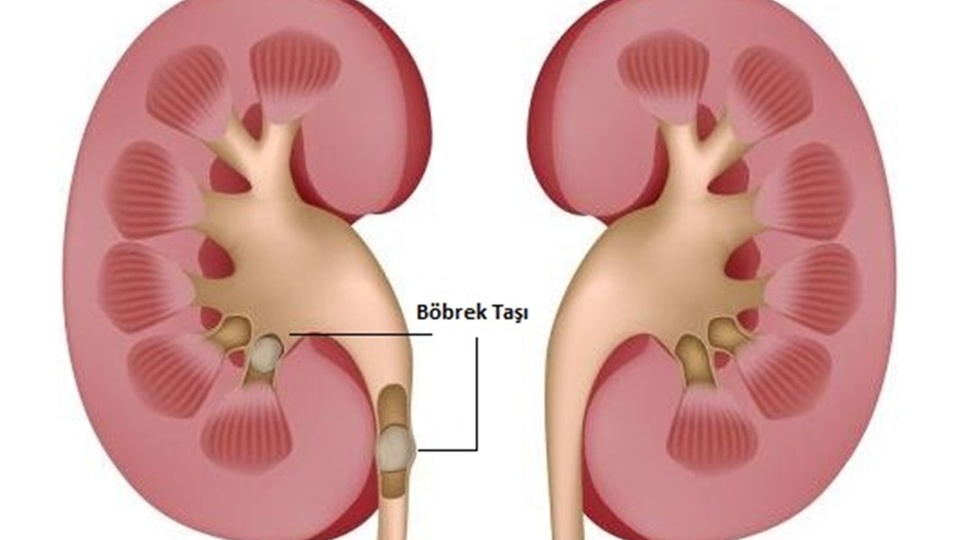 Böbrek taşı nedir?