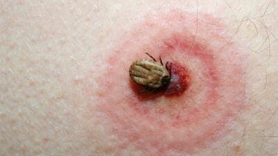 Lyme hastalığı nedir, nasıl tedavi edilir?