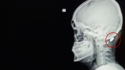 Ensesine giren mermiyle şoke oldu!