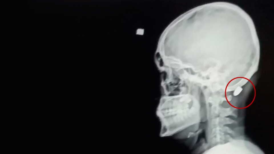 Ensesine giren mermiyle şoke oldu!