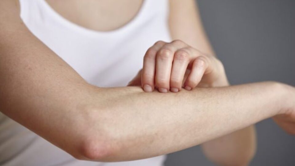 Sivrisinek alerjisi nedir, nasıl geçer?