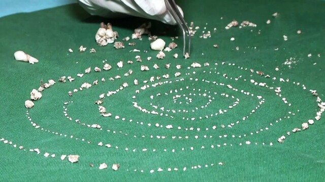 7 yaşındaki çocuğun ağzından 526 diş çıkarıldı!