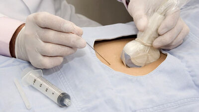 Koryon villus biyopsisi nedir?