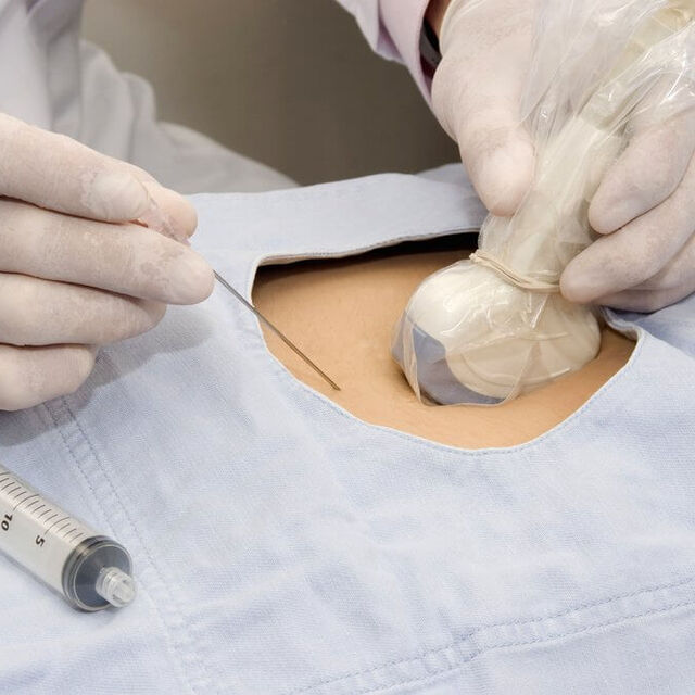 Koryon villus biyopsisi nedir?