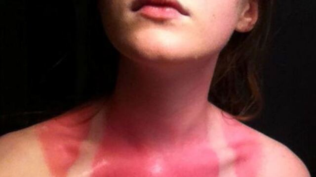 Yanığa 3 adımda müdahale!