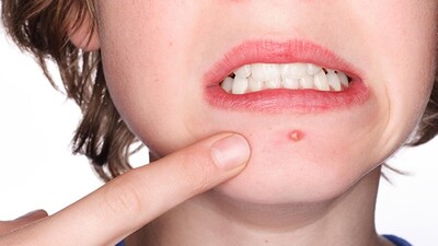 Çıban neden olur? Çıban nasıl geçer?