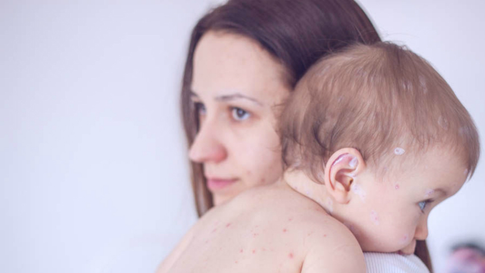 Kızamık belirtileri nelerdir?