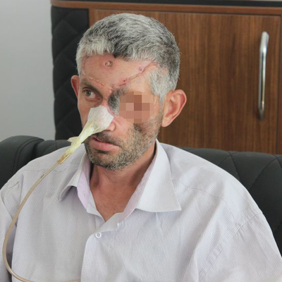 Dişini çektirmeye gitti kör oldu!