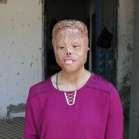 Yüzüne örtülen eşarbı yaktılar! Hayatı kabusa dönen genç kızın tek isteği...