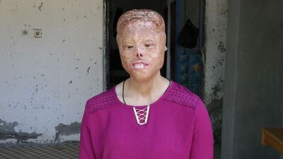 Yüzüne örtülen eşarbı yaktılar! Hayatı kabusa dönen genç kızın tek isteği...