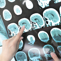 Alzheimer sandılar! Bakın ne çıktı...