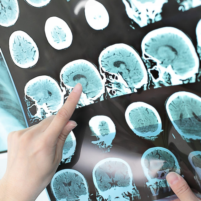 Alzheimer sandılar! Bakın ne çıktı...