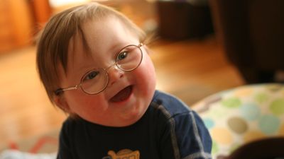 Down sendromu nedir?