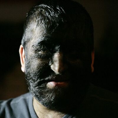 Kusurlu ilaç kurt adam yaptı!