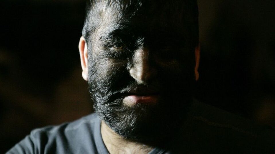 Kusurlu ilaç kurt adam yaptı!