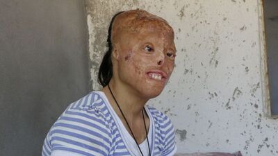 Eşarp tutuştu, yüzü ve kafa derisi yandı!