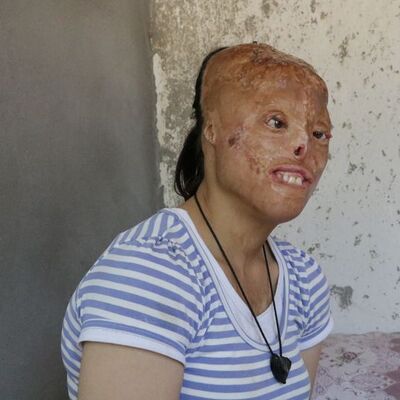 Eşarp tutuştu, yüzü ve kafa derisi yandı!