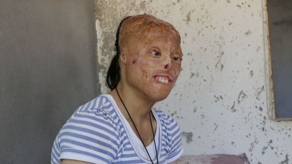 Eşarp tutuştu, yüzü ve kafa derisi yandı!