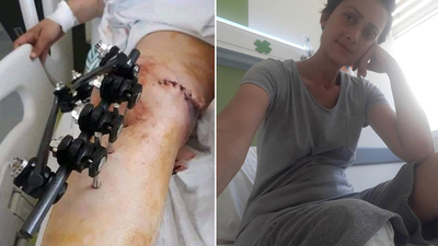 Eşinin vurduğu kadının bacağını kestiler!