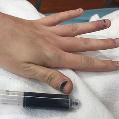 Test yapmak için kanını aldılar! Kanın rengini görünce...