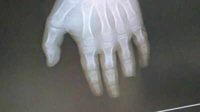 Korkunç olay! Denize girdi, parmağını kaybetti