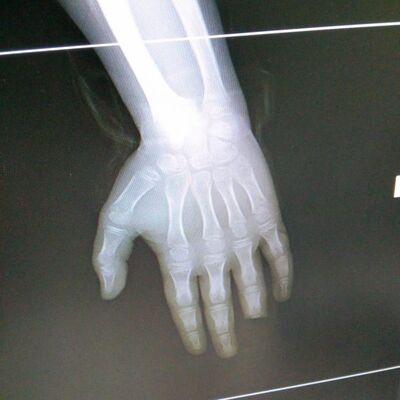 Korkunç olay! Denize girdi, parmağını kaybetti