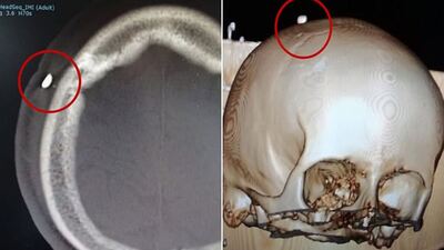 Maç sırasında kafası ısırıldı! 12 gün sonra...