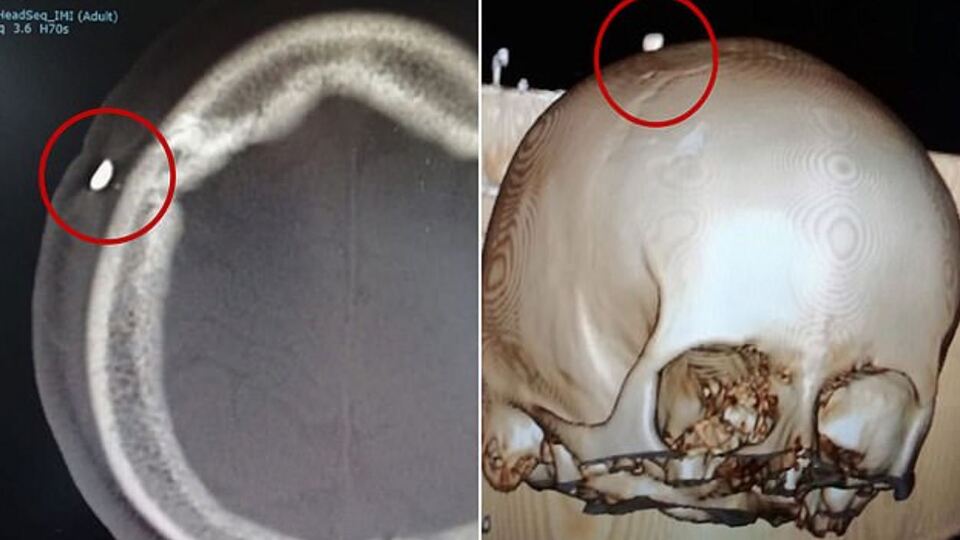 Maç sırasında kafası ısırıldı! 12 gün sonra...