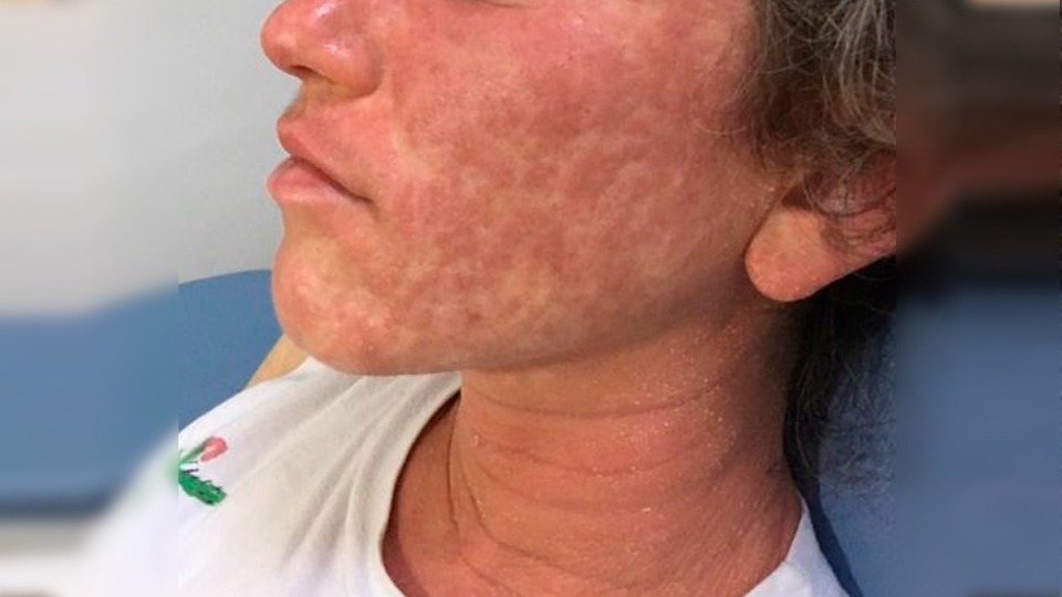 Egzama nedir? İşte belirtileri