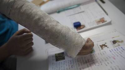 Kol kırığına alçı nasıl yapılır?