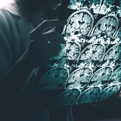 Alzheimer'ı frenlemeyi başardılar! 'Yan etkisi yok'