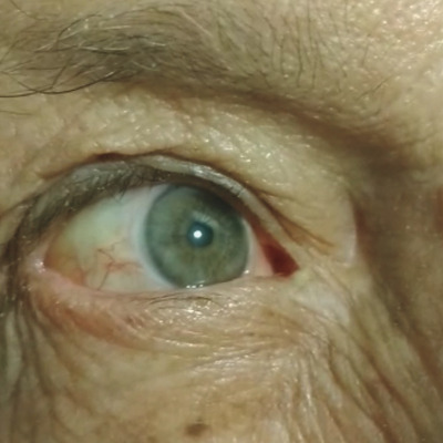 Şoke eden vaka! Kalbi gözünde atıyor!