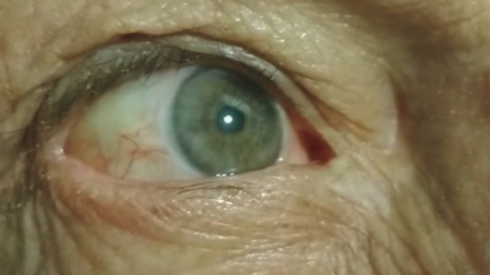 Şoke eden vaka! Kalbi gözünde atıyor!