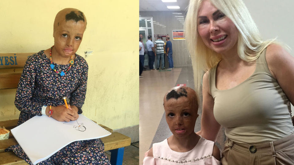 Yüzü yanan Evin'e, kendi dokusundan cilt yapılacak