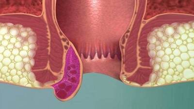 Basur (Hemoroid) belirtileri nelerdir?